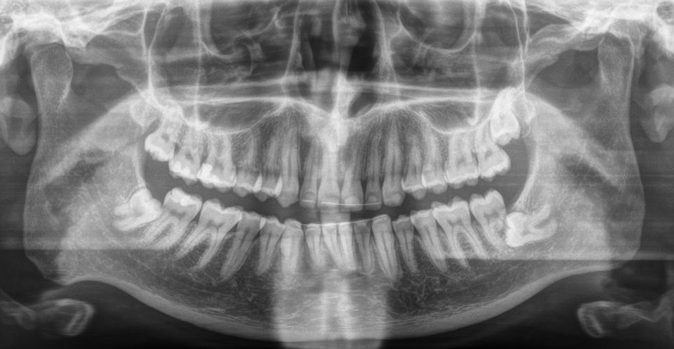 First person X-ray image displaying my teeth with a wisdom tooth visible in each quadrant, the top left one is already completely out, the others are not and the bottom right one is vertical towards and already a bit below the neighbouring tooth and has seemingly already destroyed half of its root